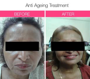 anti aging treatment In mumbai