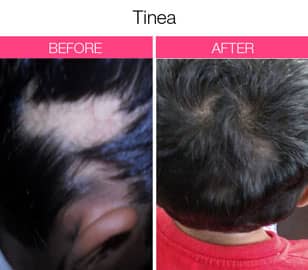 best hair fall treatment