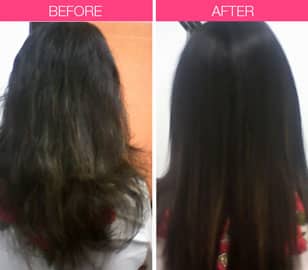 Hair fall treatment In mumbai