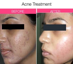 best dermatologist for acne