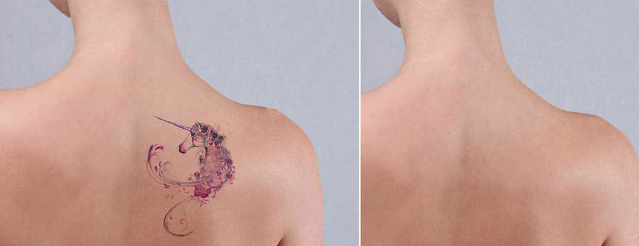 laser tattoo removal